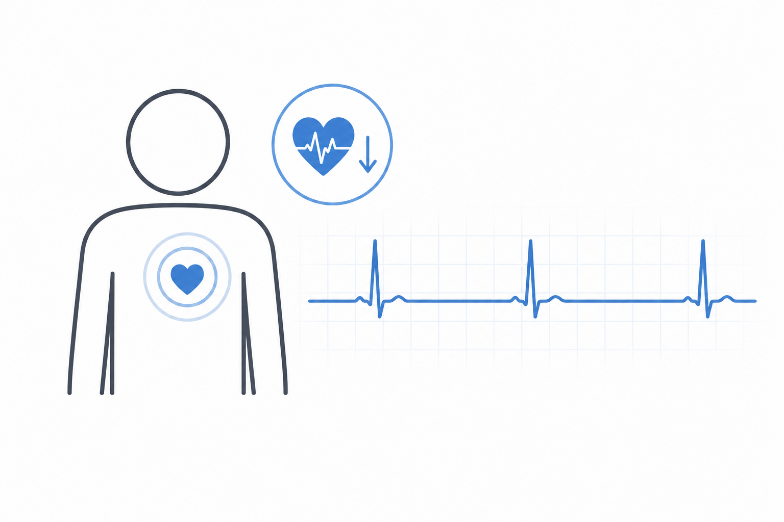 Illustration von langsamem Puls mit EKG-Kurve